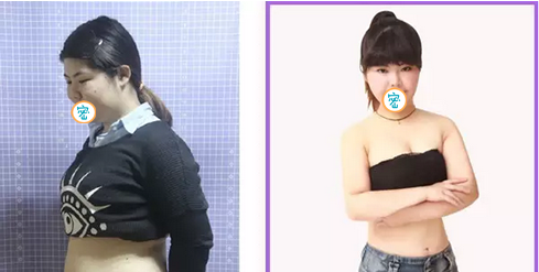 在宜宾韩美做360°环形吸脂已经1个月了 讲讲我瘦脸瘦腰的亲身经历 图2