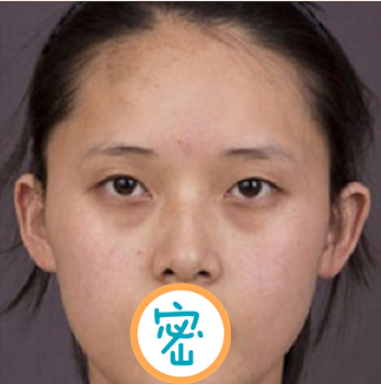 绵阳韩美彭太平光子刀双眼皮手术打造灵动双眼 术后恢复全纪录