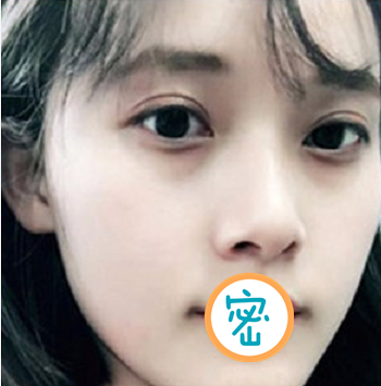 绵阳韩美彭太平光子刀双眼皮手术打造灵动双眼 术后恢复全纪录 图2