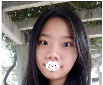 给你们瞧瞧我找珠海科美整形医院张民望院长做的双眼皮效果如何 图2
