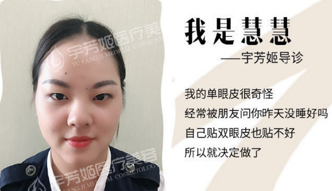 株洲宇芳姬整形郑荞安主任给员工做的双眼皮案例 你们来给打打分