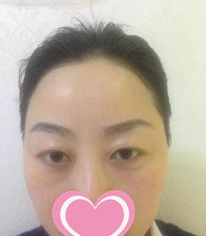 抚州梦婷整形易军学做双眼皮怎么样?看宝妈术后的恢复效果