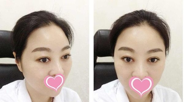 抚州梦婷整形易军学做双眼皮怎么样?看宝妈术后的恢复效果 图2