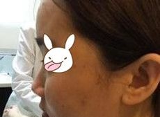 说我鼻子丑鞋拔子脸 索性在南阳维多利亚做了隆鼻