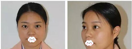 快看啊闺蜜小雪找江门华美整形美容医院欧国升院长做的隆鼻案例美翻了