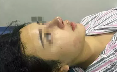 常德伊丽莎白卢开锐院长给我做的鼻失败修复两个月恢复过程
