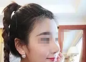 常德伊丽莎白卢开锐院长给我做的鼻失败修复两个月恢复过程 图2