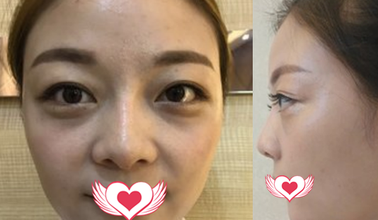 没想到在亳州的缔美做了自体脂肪填充全脸 不仅脸精致了皮肤也水当当的