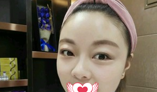 没想到在亳州的缔美做了自体脂肪填充全脸 不仅脸精致了皮肤也水当当的 图2
