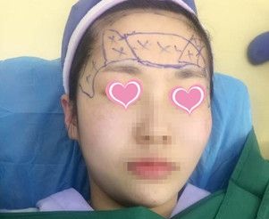 我在上饶尚美整形找王功槐做的自体脂肪丰全脸,已经10天了