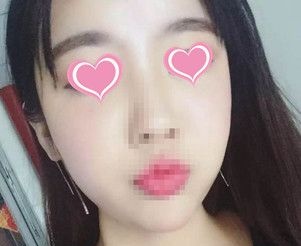 我在上饶尚美整形找王功槐做的自体脂肪丰全脸,已经10天了 图2
