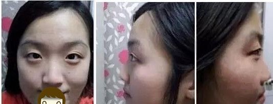 是焦作丽人让我拥有了迷人大眼和高挺鼻子 花这钱做眼鼻整形真值