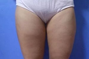 宁夏华美整形美容医院欧阳武做个腿部吸脂还真把我这130的胖子整瘦了