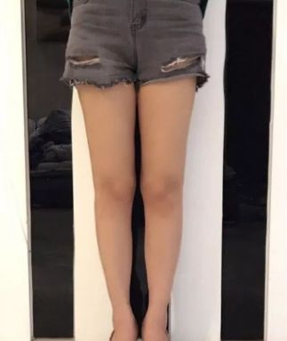 宁夏华美整形美容医院欧阳武做个腿部吸脂还真把我这130的胖子整瘦了 图2