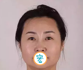 在广安悦美做了治疗 术后即刻就发现面部提升效果明显