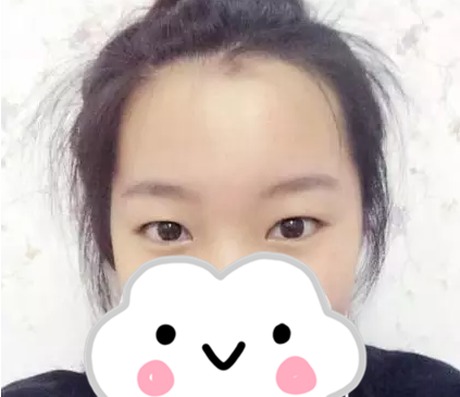 邵阳曹家美容整形医院双眼皮怎么样?真人案例