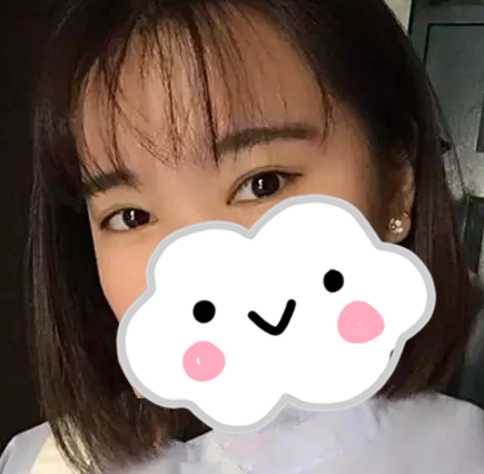邵阳曹家美容整形医院双眼皮怎么样?真人案例 图2