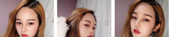 青岛华颜美做硅胶假体隆鼻手术厉害,我做完手术后恢复的也挺快的 图2