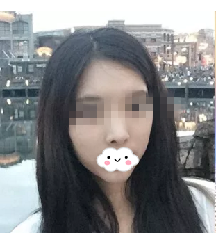 株洲华美改变了我的面部不对称,让我的美丽无可挑剔
