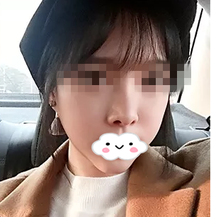 株洲华美改变了我的面部不对称,让我的美丽无可挑剔 图2