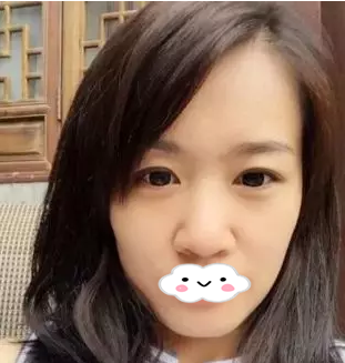 株洲希美蒋松林医生隆鼻效果怎么样?看我膨体隆鼻一个月的全过程分享