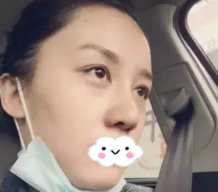 株洲希美蒋松林医生隆鼻效果怎么样?看我膨体隆鼻一个月的全过程分享 图2