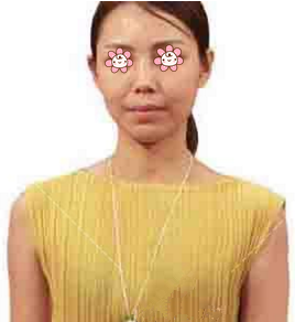 亲见宁夏华美整形美容医院何林给我妹做的自体脂肪隆胸效果我才决定也做的。