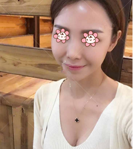 亲见宁夏华美整形美容医院何林给我妹做的自体脂肪隆胸效果我才决定也做的。 图2