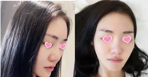 在抚州梦婷做的鼻子术后三个月了,美成了小仙女