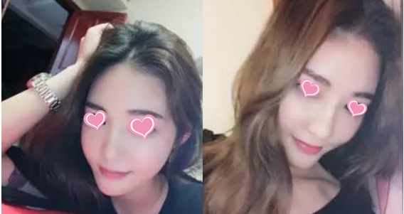在抚州梦婷做的鼻子术后三个月了,美成了小仙女 图2