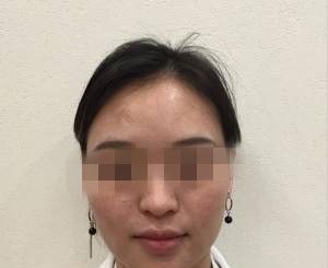 株洲华美整形好不好,看黄明光给我垫的鼻尖和面部填充,技术杠杠滴
