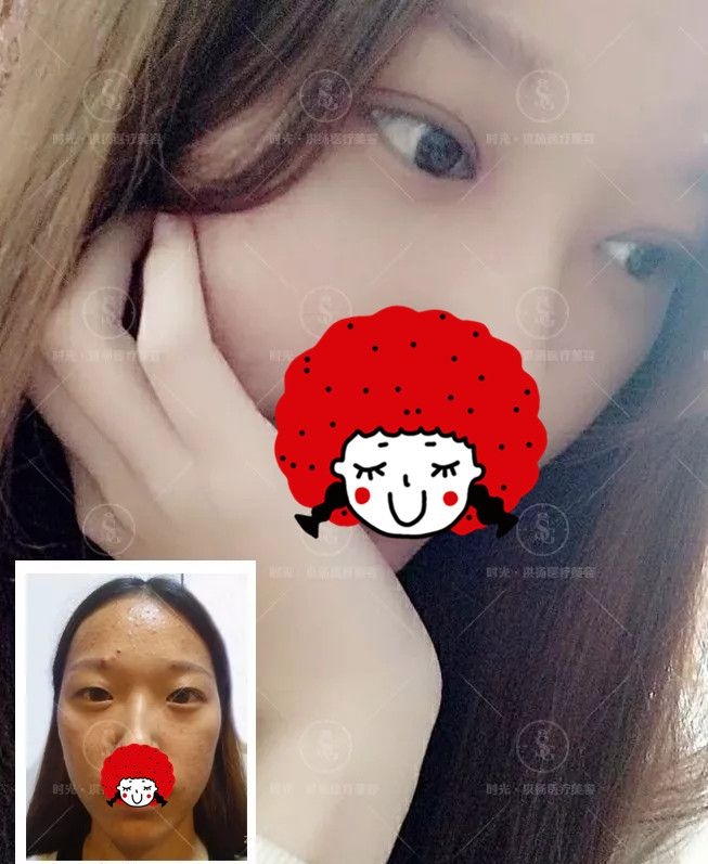 徐州时光洪扬员工蝶变：双眼皮去眼袋+皮秒祛斑祛痘，感谢曹洪扬医生拥有另一种人生