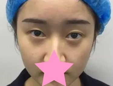 大家瞧瞧 我两个月前找包头华美整形医院白虎割的双眼皮好不好