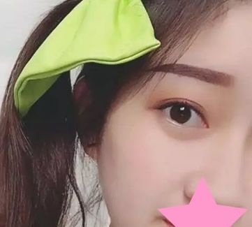 大家瞧瞧 我两个月前找包头华美整形医院白虎割的双眼皮好不好 图2