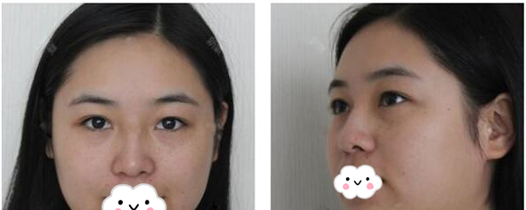 珠海哪里割双眼皮好?朋友推荐我找珠海九龙整形美容医院做的切开双眼皮