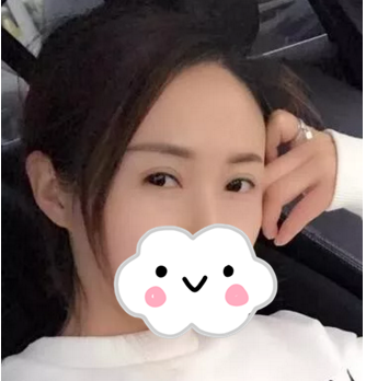 我在湘潭雅美双眼皮修复半年了，大家都说好自然，年轻又回来了 案例图2