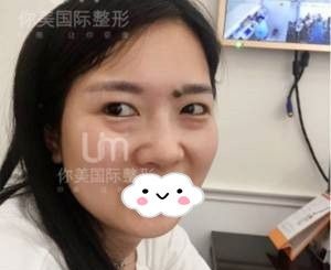 回顾我不开刀祛眼袋的心路历程,为曾祥宏医生的技术点赞