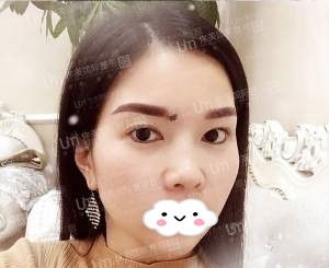 回顾我不开刀祛眼袋的心路历程,为曾祥宏医生的技术点赞 图2