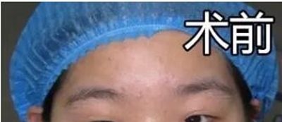 表姐带我去周口缔莱美做双眼皮修复 感谢李士成主任挽救了我的失败双眼皮