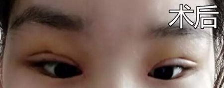 表姐带我去周口缔莱美做双眼皮修复 感谢李士成主任挽救了我的失败双眼皮 图2