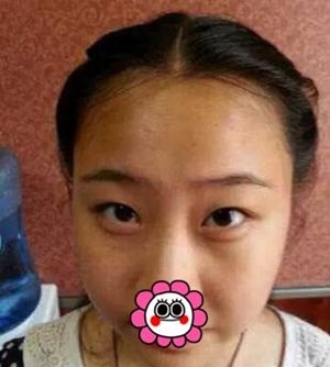 许昌丽娜整形韩式微创双眼皮手术真人体验 术后让我变身清新大眼萌妹子