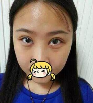 许昌丽娜整形韩式微创双眼皮手术真人体验 术后让我变身清新大眼萌妹子 图2