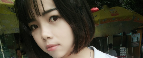想了很久还是决定找茂名华美整形医院于海生医生做了切开双眼皮