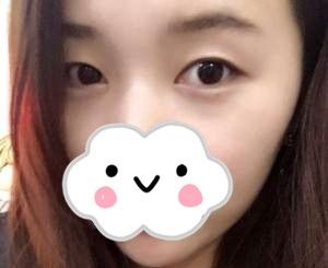 我在衡阳曹家整形做的双眼皮,看我的整个过程,相信你也会为刘健院长的技术点赞