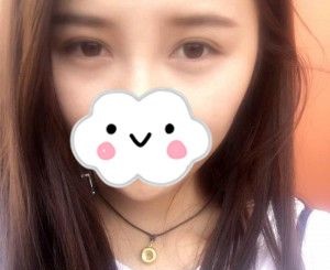我在衡阳曹家整形做的双眼皮,看我的整个过程,相信你也会为刘健院长的技术点赞 图2