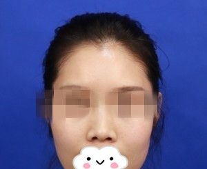 分享我在株洲华美年华做假体隆鼻+垫下巴一个多月的恢复过程