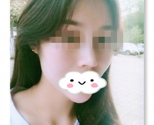 分享我在株洲华美年华做假体隆鼻+垫下巴一个多月的恢复过程 图2