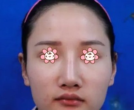 哦，我在新疆黎美整形医院王丽凤那儿做下颌角+颧弓内推是去年1月26的事儿