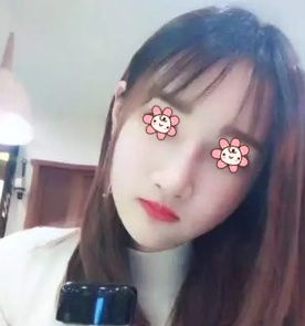 哦，我在新疆黎美整形医院王丽凤那儿做下颌角+颧弓内推是去年1月26的事儿 案例图2