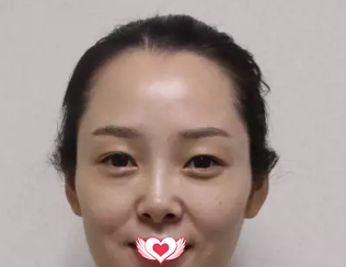 大龄女自述在沧州静港注射完玻尿酸分分钟面部饱满变萝莉 10天后法令纹和泪沟全消失